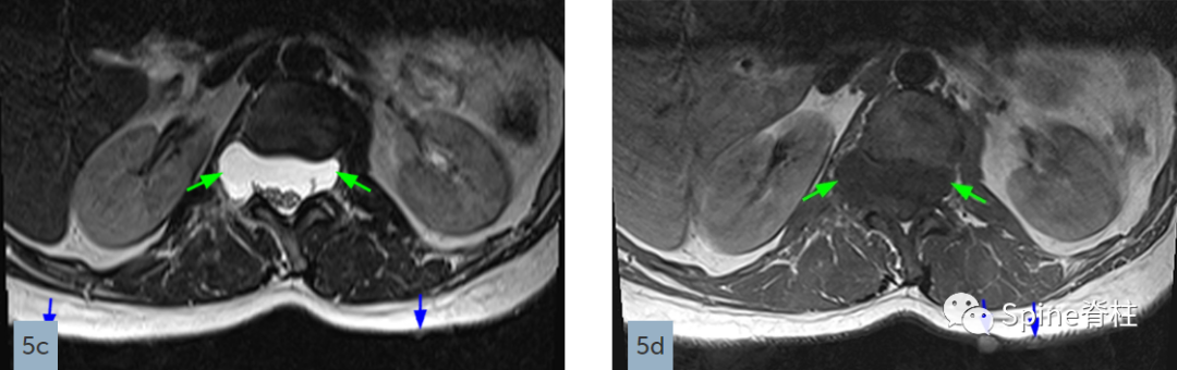 影像PPT - 【病例】硬膜扩张 (dural ectasia)1例MR影像-12 影像PPT - 【病例】硬膜扩张 (dural ectasia)1例MR影像-12