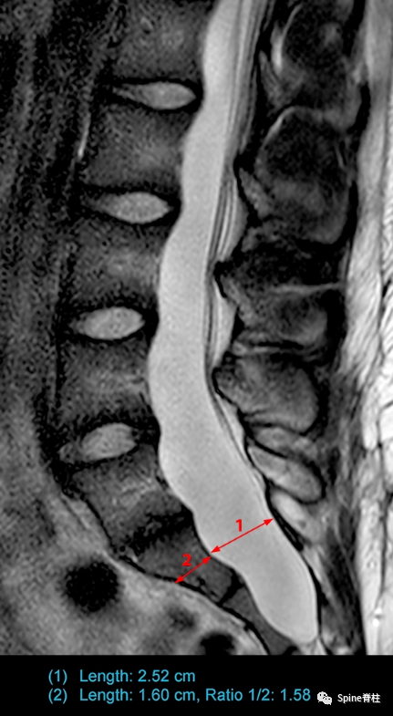 影像PPT - 【病例】硬膜扩张 (dural ectasia)1例MR影像-10 影像PPT - 【病例】硬膜扩张 (dural ectasia)1例MR影像-10