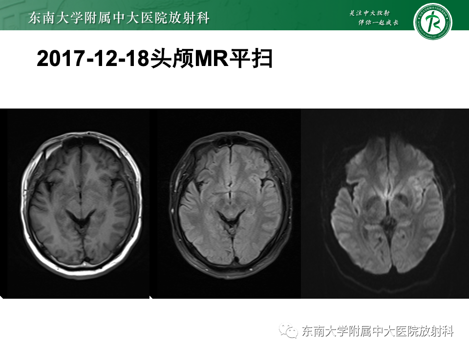 影像PPT - 【PPT】弥漫脑膜强化病变的影像诊断-2
