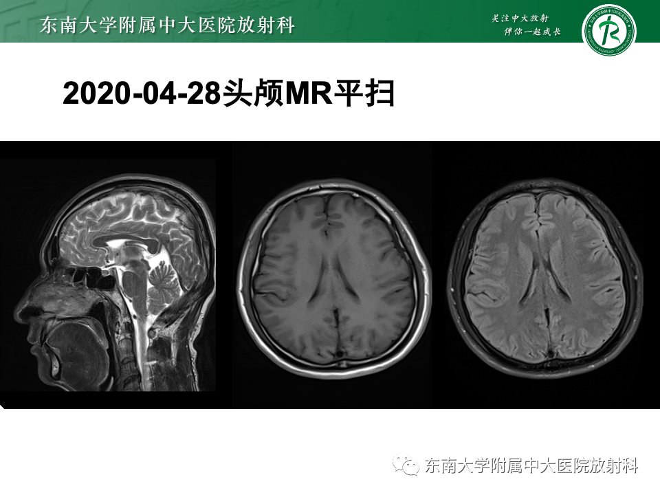 影像PPT - 【PPT】弥漫脑膜强化病变的影像诊断-5
