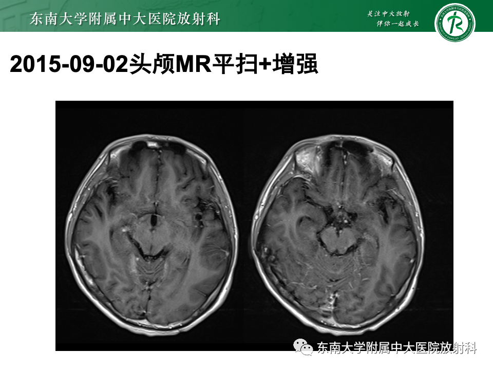 影像PPT - 【PPT】弥漫脑膜强化病变的影像诊断-11