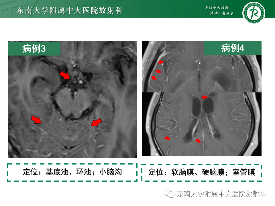 影像PPT - 【PPT】弥漫脑膜强化病变的影像诊断-34