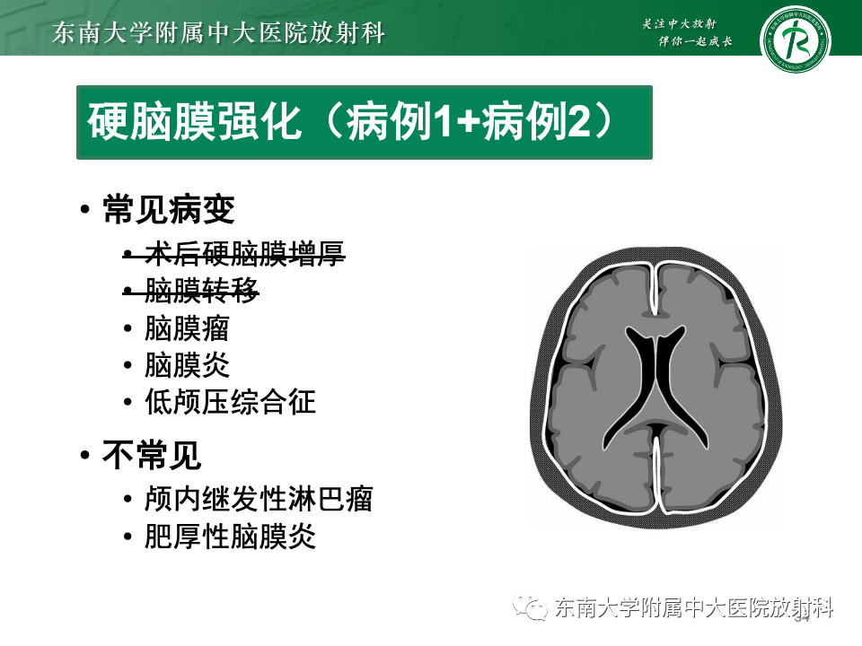 影像PPT - 【PPT】弥漫脑膜强化病变的影像诊断-35