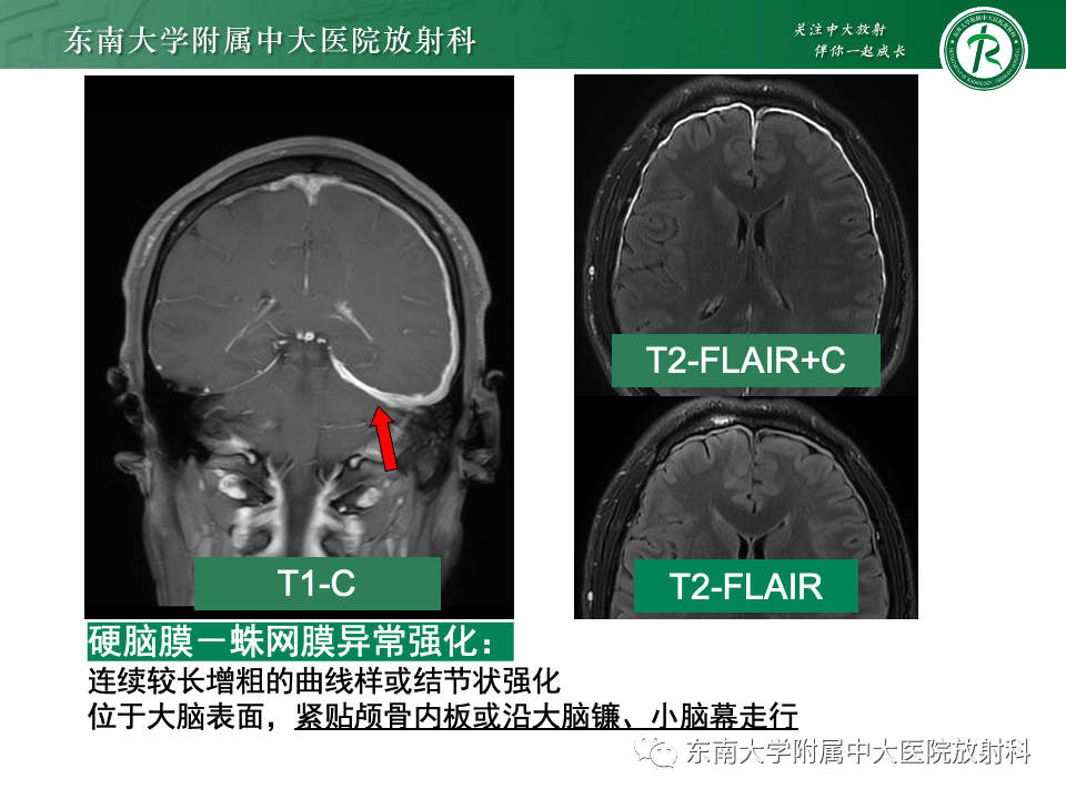 影像PPT - 【PPT】弥漫脑膜强化病变的影像诊断-29