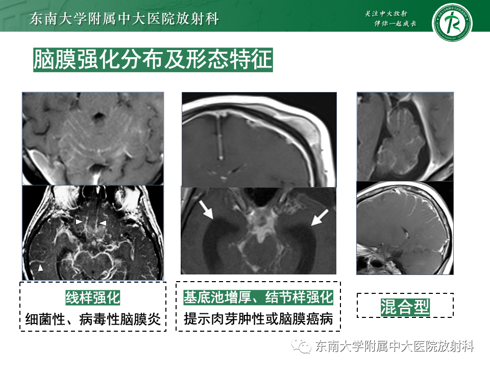 影像PPT - 【PPT】弥漫脑膜强化病变的影像诊断-32