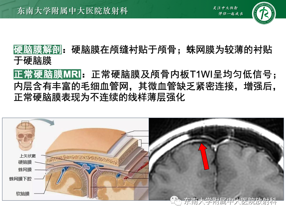 影像PPT - 【PPT】弥漫脑膜强化病变的影像诊断-28