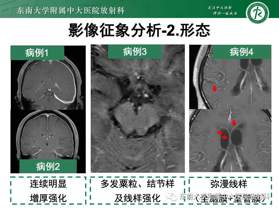 影像PPT - 【PPT】弥漫脑膜强化病变的影像诊断-38