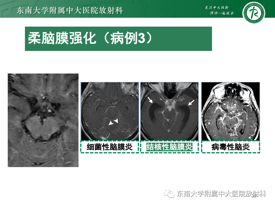 影像PPT - 【PPT】弥漫脑膜强化病变的影像诊断-40