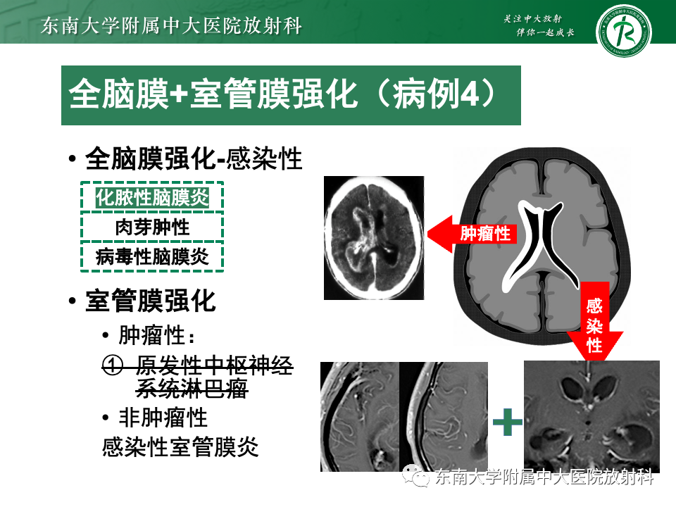 影像PPT - 【PPT】弥漫脑膜强化病变的影像诊断-41