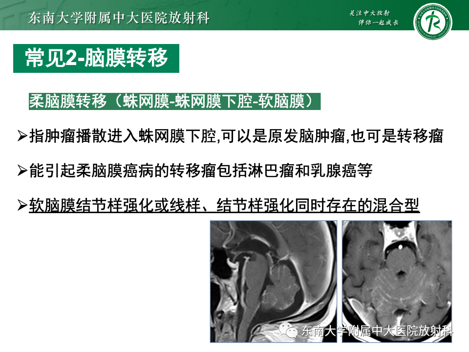 影像PPT - 【PPT】弥漫脑膜强化病变的影像诊断-57