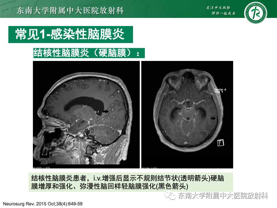 影像PPT - 【PPT】弥漫脑膜强化病变的影像诊断-51