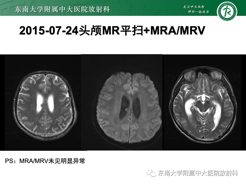 影像PPT - 【PPT】弥漫脑膜强化病变的影像诊断-9