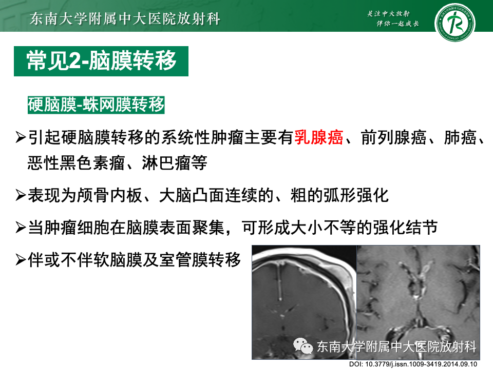 影像PPT - 【PPT】弥漫脑膜强化病变的影像诊断-56
