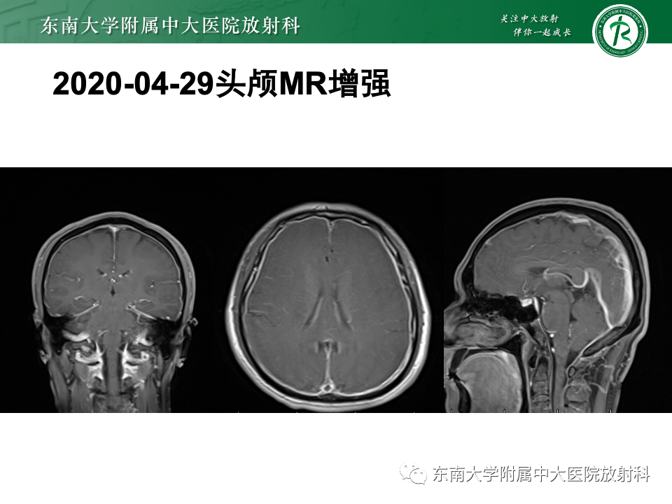 影像PPT - 【PPT】弥漫脑膜强化病变的影像诊断-6