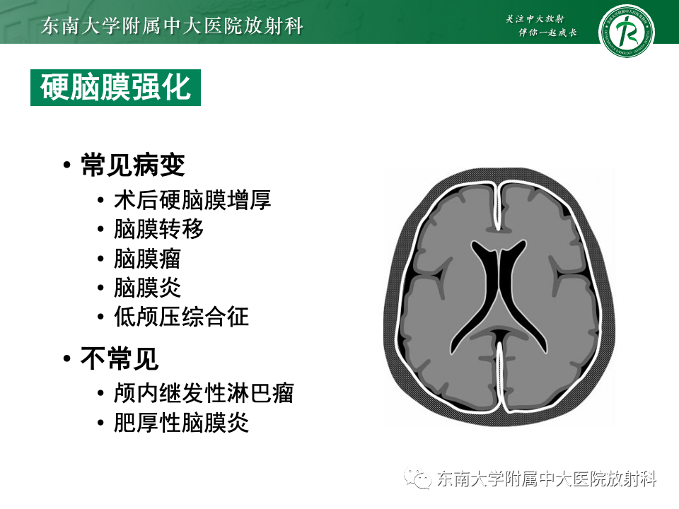 影像PPT - 【PPT】弥漫脑膜强化病变的影像诊断-60