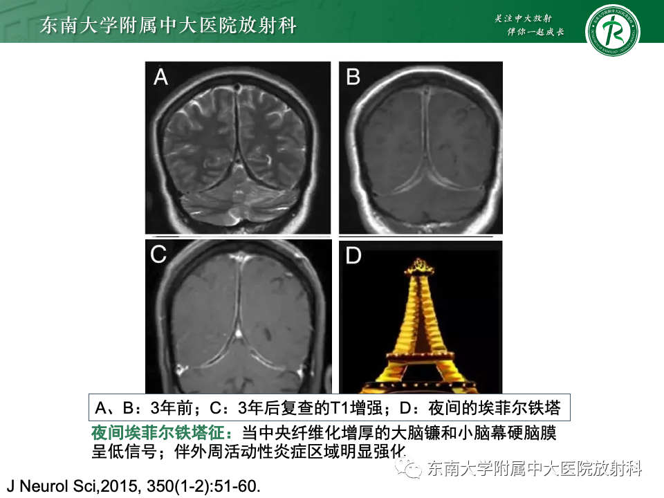 影像PPT - 【PPT】弥漫脑膜强化病变的影像诊断-68