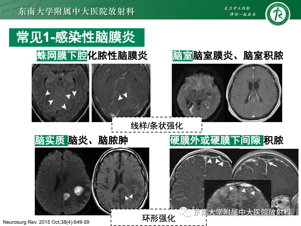 影像PPT - 【PPT】弥漫脑膜强化病变的影像诊断-47