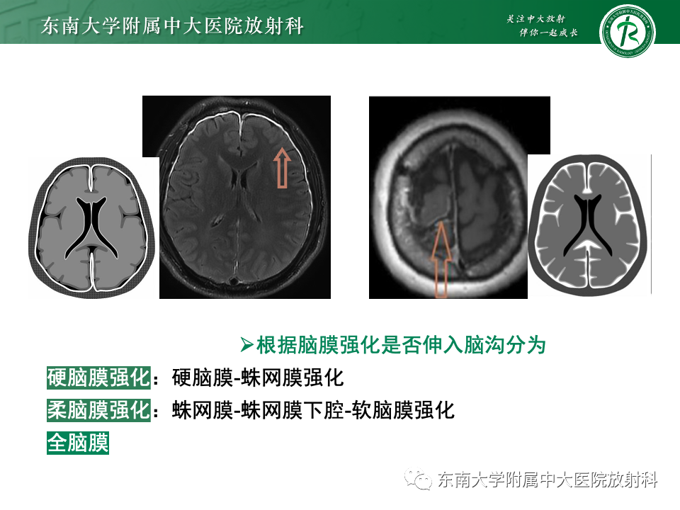 影像PPT - 【PPT】弥漫脑膜强化病变的影像诊断-31