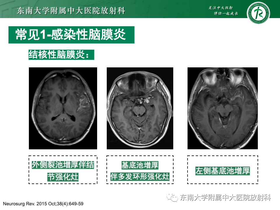 影像PPT - 【PPT】弥漫脑膜强化病变的影像诊断-50