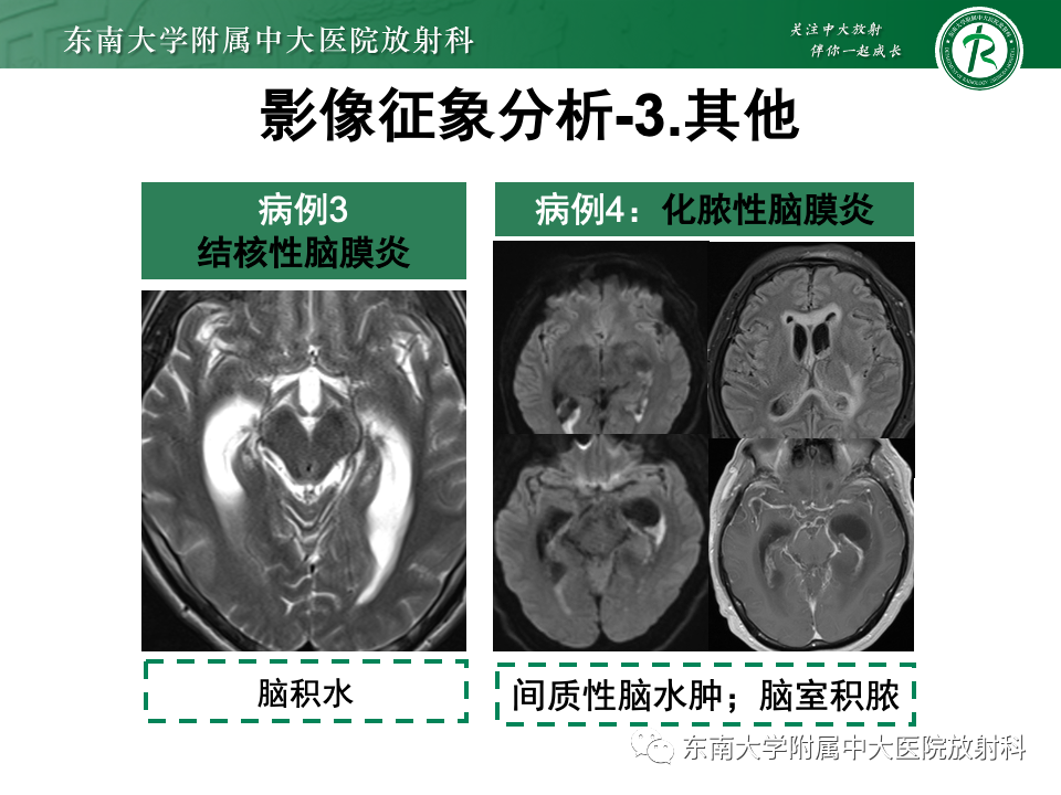 影像PPT - 【PPT】弥漫脑膜强化病变的影像诊断-43