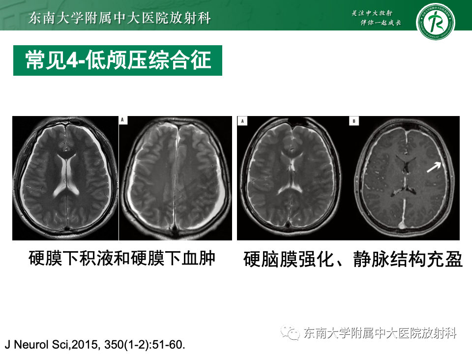 影像PPT - 【PPT】弥漫脑膜强化病变的影像诊断-65