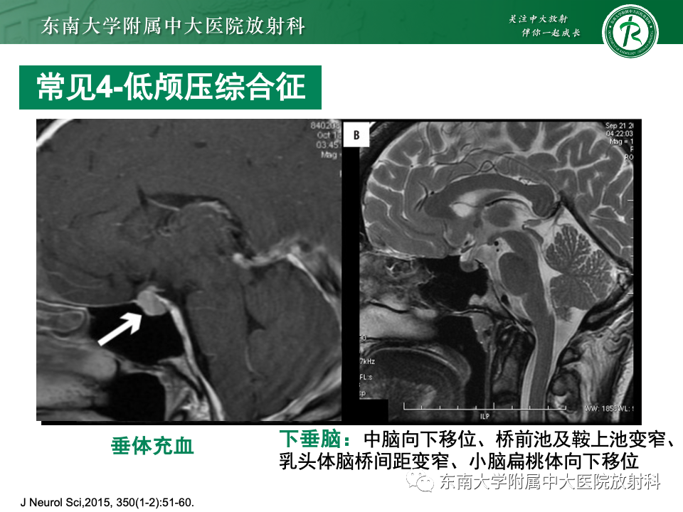 影像PPT - 【PPT】弥漫脑膜强化病变的影像诊断-66