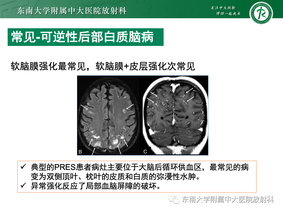 影像PPT - 【PPT】弥漫脑膜强化病变的影像诊断-70
