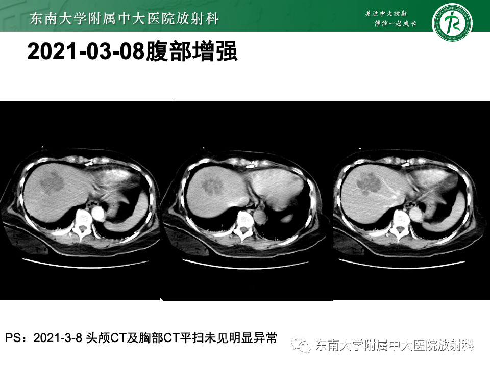 影像PPT - 【PPT】弥漫脑膜强化病变的影像诊断-13