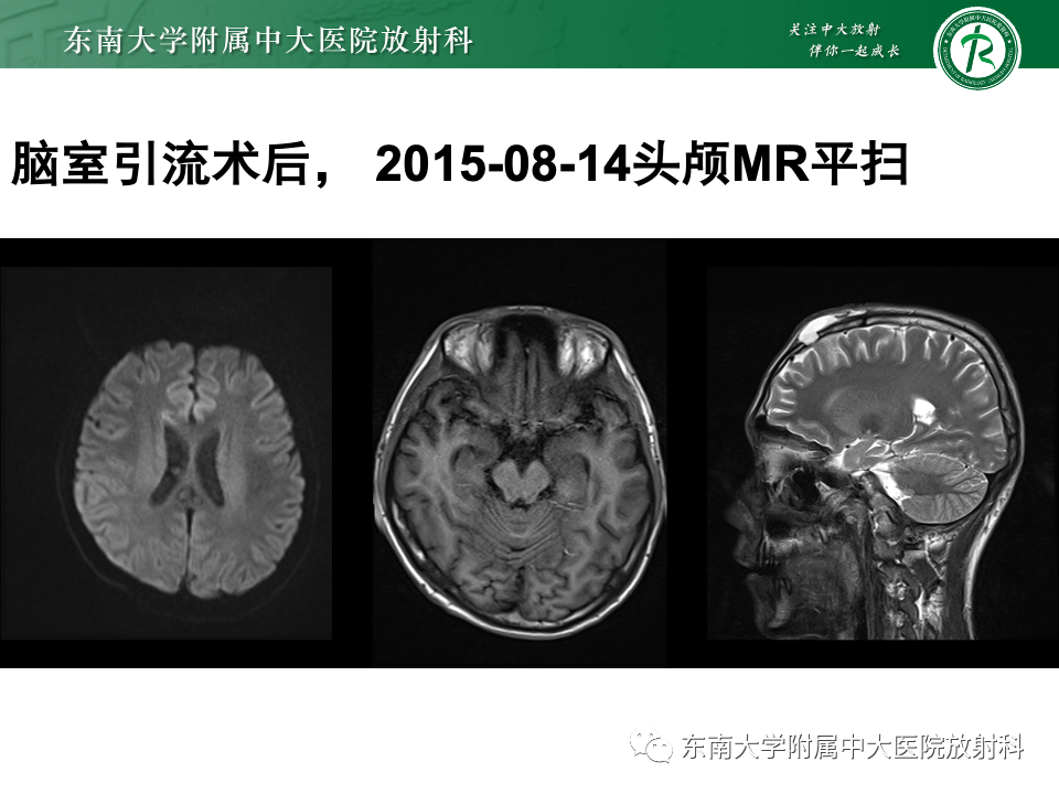 影像PPT - 【PPT】弥漫脑膜强化病变的影像诊断-10
