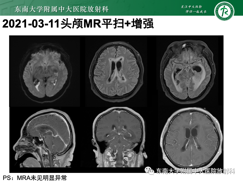 影像PPT - 【PPT】弥漫脑膜强化病变的影像诊断-2