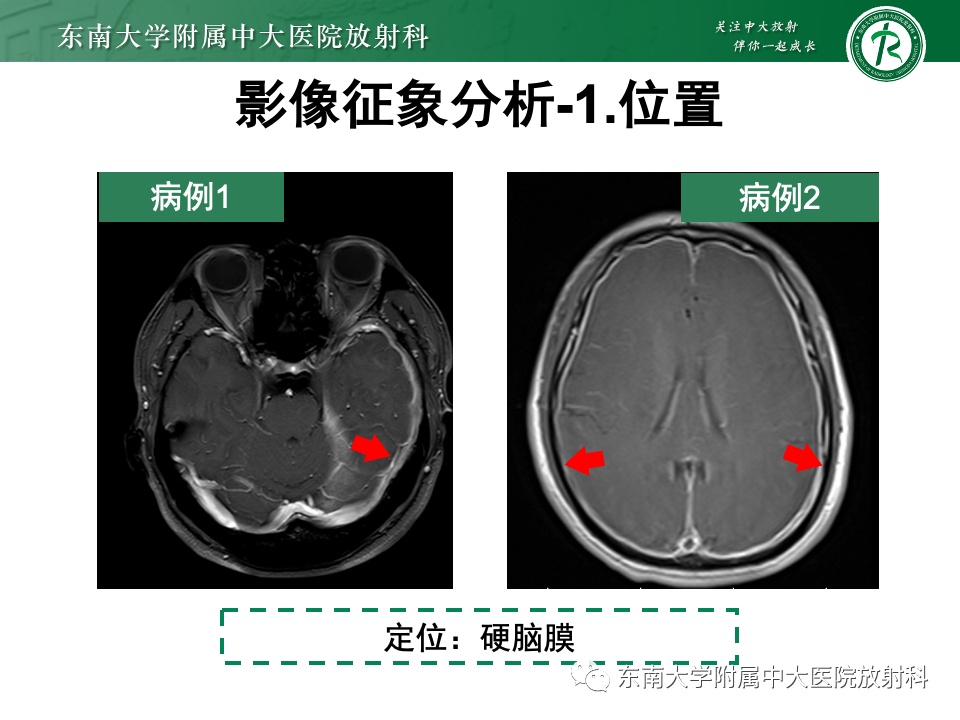 影像PPT - 【PPT】弥漫脑膜强化病变的影像诊断-5