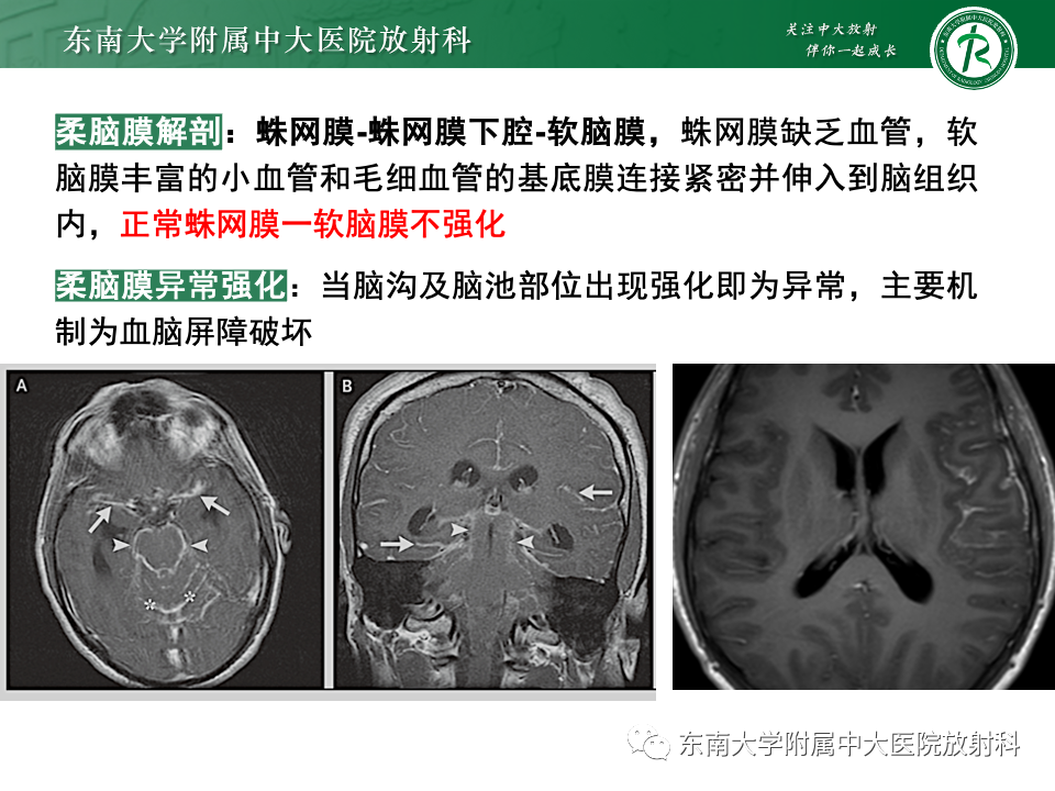 影像PPT - 【PPT】弥漫脑膜强化病变的影像诊断-4