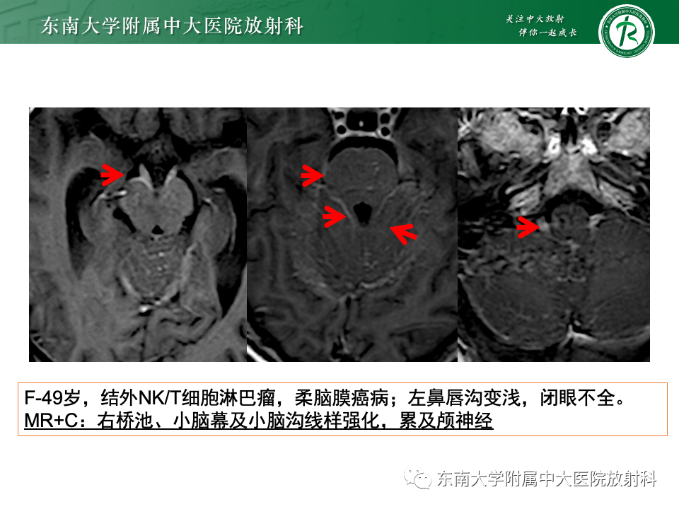 影像PPT - 【PPT】弥漫脑膜强化病变的影像诊断-11