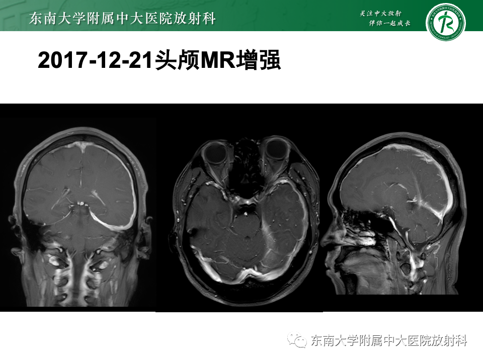 影像PPT - 【PPT】弥漫脑膜强化病变的影像诊断-1