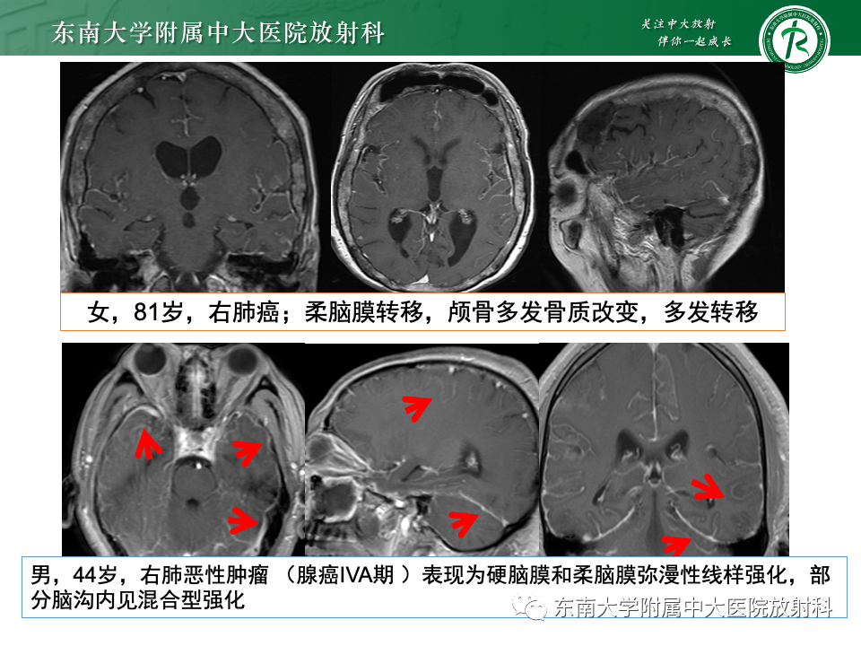 影像PPT - 【PPT】弥漫脑膜强化病变的影像诊断-1