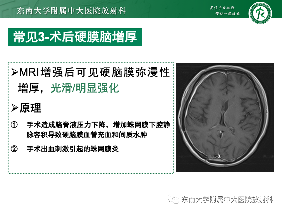 影像PPT - 【PPT】弥漫脑膜强化病变的影像诊断-1