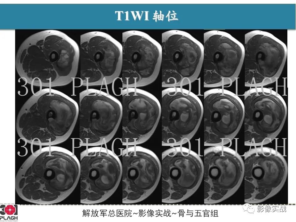 影像PPT - 【病例】大腿腱鞘巨细胞瘤1例MR-3