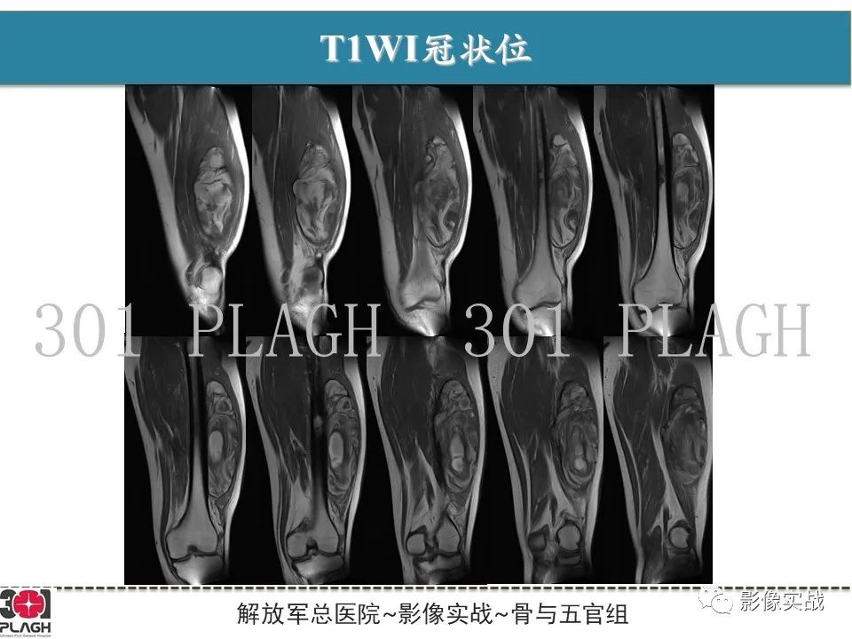 影像PPT - 【病例】大腿腱鞘巨细胞瘤1例MR-7