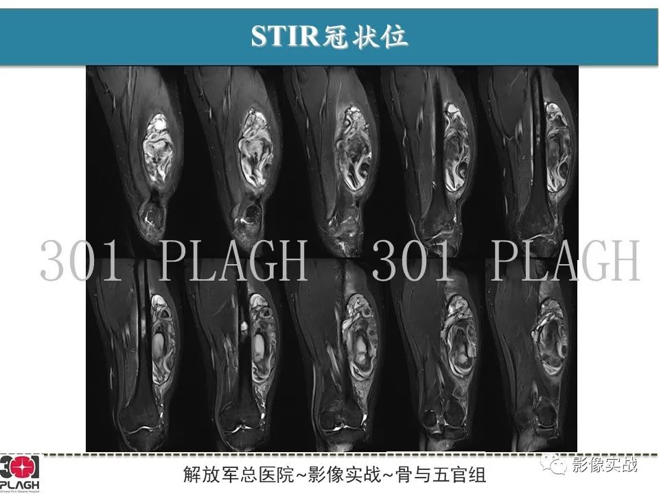 影像PPT - 【病例】大腿腱鞘巨细胞瘤1例MR-6