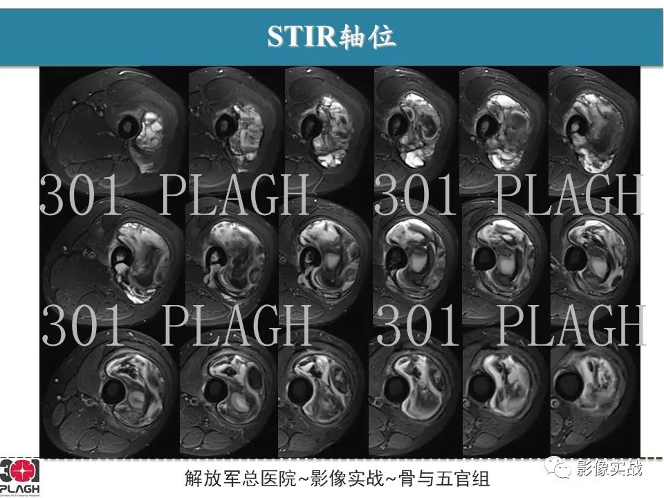 影像PPT - 【病例】大腿腱鞘巨细胞瘤1例MR-4