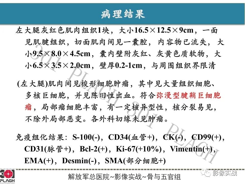 影像PPT - 【病例】大腿腱鞘巨细胞瘤1例MR-9