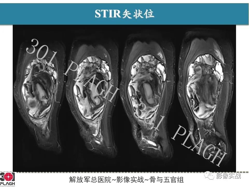 影像PPT - 【病例】大腿腱鞘巨细胞瘤1例MR-5