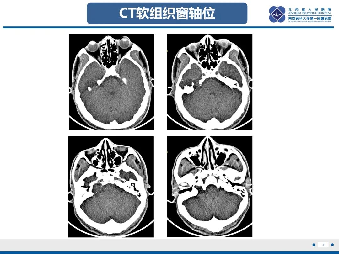 影像PPT - 【PPT】岩尖胆脂瘤-3
