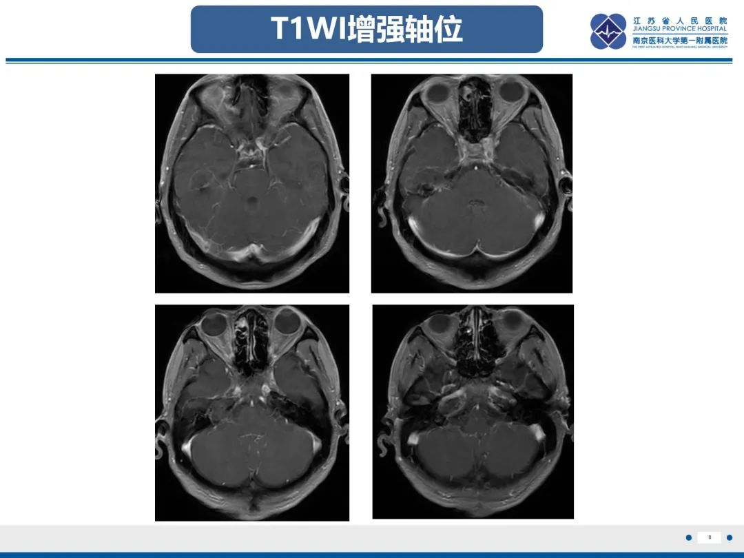 影像PPT - 【PPT】岩尖胆脂瘤-9