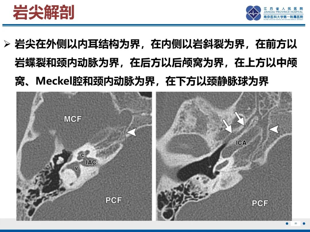 影像PPT - 【PPT】岩尖胆脂瘤-24