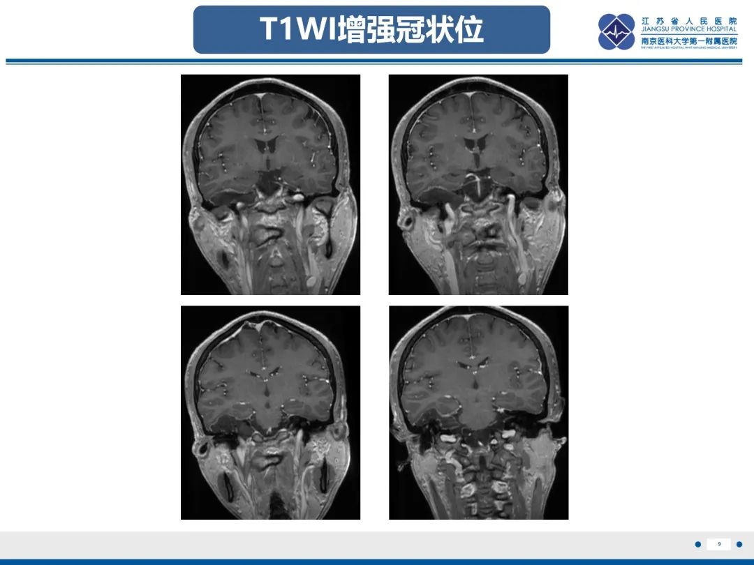 影像PPT - 【PPT】岩尖胆脂瘤-10