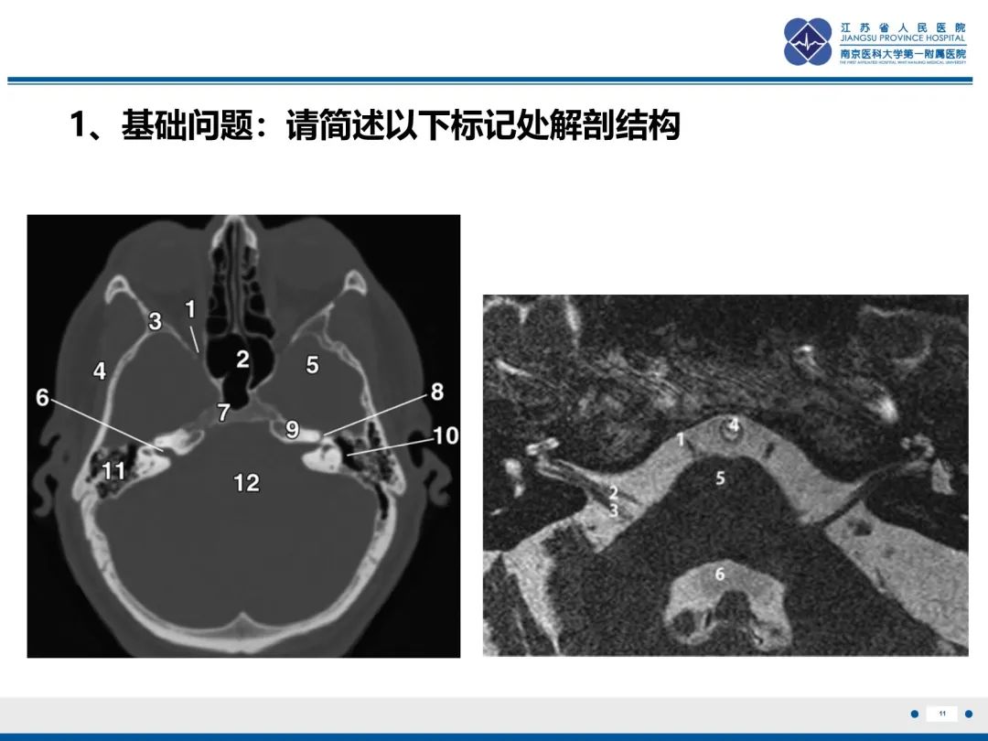 影像PPT - 【PPT】岩尖胆脂瘤-12