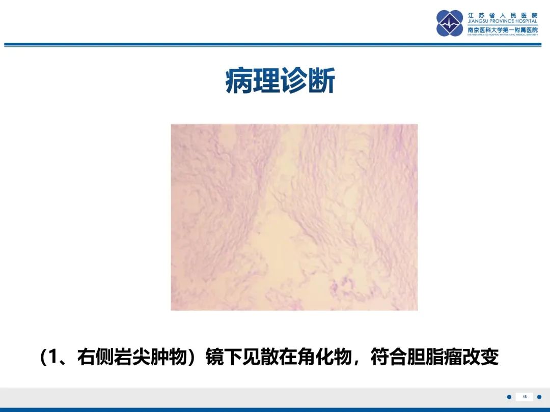 影像PPT - 【PPT】岩尖胆脂瘤-19