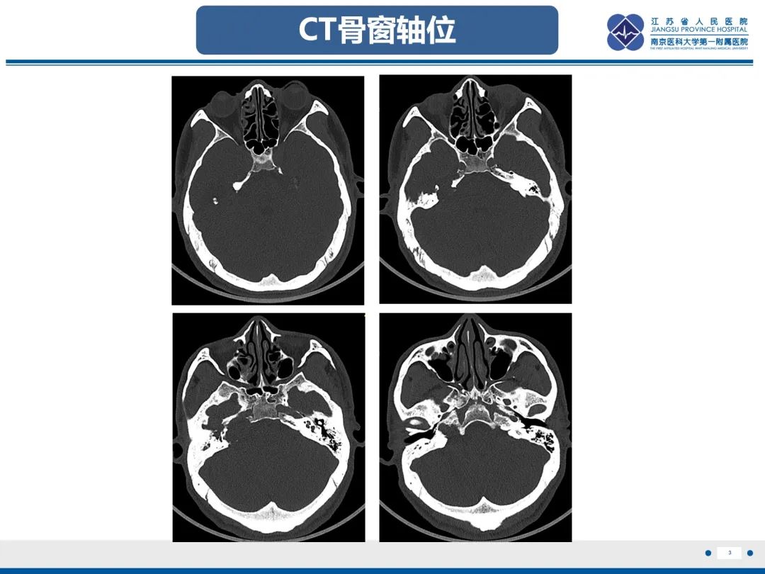 影像PPT - 【PPT】岩尖胆脂瘤-4