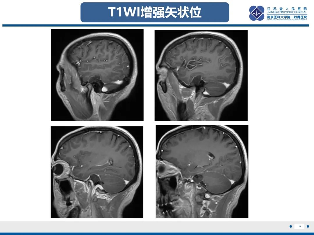 影像PPT - 【PPT】岩尖胆脂瘤-11